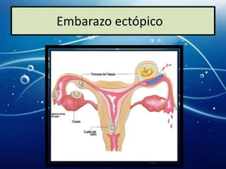 Embarazo ectópico
 