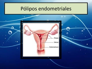 Pólipos endometriales
 