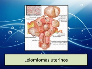 Leiomiomas uterinos
 