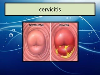 cervicitis
 