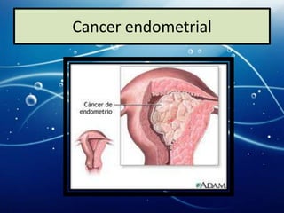 Cancer endometrial
 