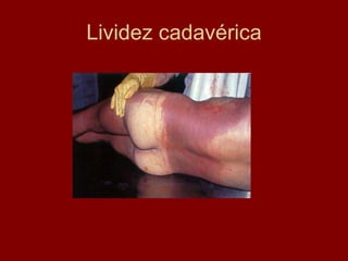 Lividez cadavérica 