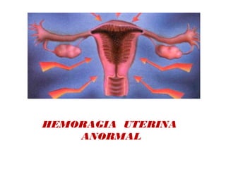 HEMORAGIA UTERINA
ANORMAL
 