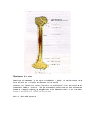 }Clasificación de la lesión
Realizamos una radiografía, en los planos anteroposterior y lateral, con tracción manual de la
pierna afectada, que incluyera las articulaciones proximal y distal.
Tomamos como referencia los criterios propuestos por la Orthopaedic Trauma Association (4) de
conocimiento universal, y prácticos, a los que se añadieron modificaciones del autor para tener en
cuenta la localización anatómica y vascularización de los fragmentos (figura 1), así como evitar
errores de apreciación en la medición del defecto óseo.
Figura 1: Localización anatómica
 