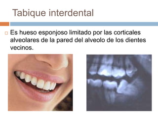 Tabique interdentalEs hueso esponjoso limitado por las corticales alveolares de la pared del alveolo de los dientes vecinos.