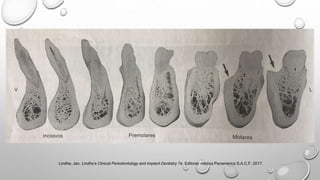 Lindhe, Jan. Lindhe’s Clinical Periodontology and Implant Dentistry 7e. Editorial médica Panamerica S.A.C.F, 2017.
 