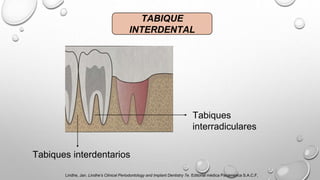 TABIQUE
INTERDENTAL
Tabiques interdentarios
Tabiques
interradiculares
Lindhe, Jan. Lindhe’s Clinical Periodontology and Implant Dentistry 7e. Editorial médica Panamerica S.A.C.F,
 