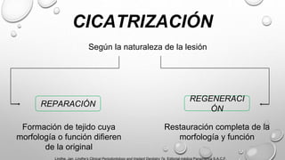 CICATRIZACIÓN
REPARACIÓN
REGENERACI
ÓN
Según la naturaleza de la lesión
Formación de tejido cuya
morfología o función difieren
de la original
Restauración completa de la
morfología y función
Lindhe, Jan. Lindhe’s Clinical Periodontology and Implant Dentistry 7e. Editorial médica Panamerica S.A.C.F,
 