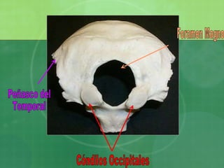 Cóndilos Occipitales Peñasco del  Temporal Foramen Magno 