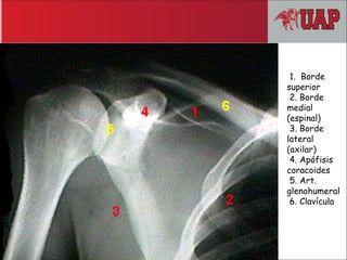 1. Borde
superior
2. Borde
medial
(espinal)
3. Borde
lateral
(axilar)
4. Apófisis
coracoides
5. Art.
glenohumeral
6. Clavícula
 