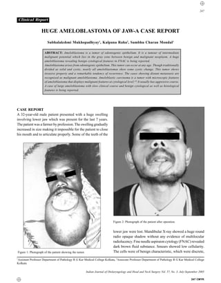 247


 Clinical Report


                   HUGE AMELOBLASTOMA OF JAW-A CASE REPORT
                       Subhalakshmi Mukhopadhyay1, Kalpana Raha2, Sambhu Charan Mondal1

                     ABSTRACT: Ameloblastoma is a tumor of odontogenic epithelium. It is a tumour of intermediate
                     malignant potential which lies in the gray zone between benign and malignant neoplasm. A huge
                     ameloblastoma revealing benign cytological features in FNAC is being reported.
                     Ameloblastoma arises from odontogenic epithelium. This tumor can occur at any age. Though traditionally
                     divided as solid and cystic, nearly all ameloblastomas show some cystic change. This tumor shows
                     invasive property and a remarkable tendency of recurrence. The cases showing distant metastasis are
                     recognized as malignant ameloblastoma. Ameloblastic carcinoma is a tumor with microscopic features
                     of ameloblastoma that displays malignant features at cytological level. [2] It usually has aggressive course.
                     A case of large ameloblastoma with slow clinical course and benign cytological as well as histological
                     features is being reported.




CASE REPORT
A 32-year-old male patient presented with a huge swelling
involving lower jaw which was present for the last 7 years.
The patient was a farmer by profession. The swelling gradually
increased in size making it impossible for the patient to close
his mouth and to articulate properly. Some of the teeth of the




                                                                              Figure 2: Photograph of the patient after operation.


                                                                              lower jaw were lost. Mandibular X-ray showed a huge round
                                                                              radio opaque shadow without any evidence of multilocular
                                                                              radiolucency. Fine needle aspiraion cytology (FNAC) revealed
                                                                              dark brown fluid substance. Smears showed low cellularity.
Figure 1: Photograph of the patient showing the tumor.                        The cells were of benign characteristic, which were discrete,
1
  Assistant Professor Department of Pathology R G Kar Medical College Kolkata, 2Associate Professor Department of Pathology R G Kar Medical College
Kolkata

                                                         Indian Journal of Otolaryngology and Head and Neck Surgery Vol. 57, No. 3, July-September 2005

                                                                                                                                            247 CMYK
 