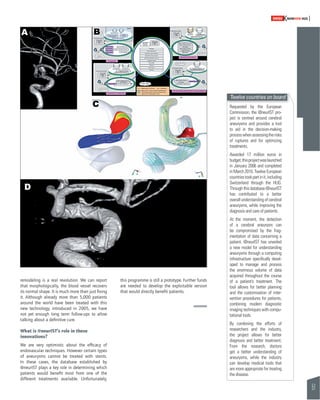 51 
SWISSKNOWHOW HUG 
remodeling is a real revolution. We can report 
that morphologically, the blood vessel recovers 
its normal shape. It is much more than just fi xing 
it. Although already more than 5,000 patients 
around the world have been treated with this 
new technology, introduced in 2005, we have 
not yet enough long term follow-ups to allow 
talking about a defi nitive cure. 
What is @neurIST’s role in these 
innovations? 
We are very optimistic about the effi cacy of 
endovascular techniques. However certain types 
of aneurysms cannot be treated with stents. 
In these cases, the database established by 
@neurIST plays a key role in determining which 
patients would benefi t most from one of the 
different treatments available. Unfortunately, 
this programme is still a prototype. Further funds 
are needed to develop the exploitable version 
that would directly benefi t patients. 
Twelve countries on board 
Requested by the European 
Commission, the @neurIST pro-ject 
is centred around cerebral 
aneurysms and provides a tool 
to aid in the decision-making 
process when assessing the risks 
of ruptures and for optimizing 
treatments. 
Awarded 17 million euros in 
budget, this project was launched 
in January 2006 and completed 
in March 2010. Twelve European 
countries took part in it, including 
Switzerland through the HUG. 
Through this database @neurIST 
has contributed to a better 
overall understanding of cerebral 
aneurysms, while improving the 
diagnosis and care of patients. 
At the moment, the detection 
of a cerebral aneurysm can 
be compromised by the frag-mentation 
of data concerning a 
patient. @neurIST has unveiled 
a new model for understanding 
aneurysms through a computing 
infrastructure specifi cally devel-oped 
to manage and process 
the enormous volume of data 
acquired throughout the course 
of a patient’s treatment. The 
tool allows for better planning 
and the customisation of inter - 
vention procedures for patients, 
combining modern diagnostic 
imaging techniques with compu-tational 
tools. 
By combining the efforts of 
researchers and the industry, 
the project allows for better 
diagnosis and better treatment. 
From the research, doctors 
get a better understanding of 
aneurysms, while the industry 
can develop medical tools that 
are more appropriate for treating 
the disease. 
 