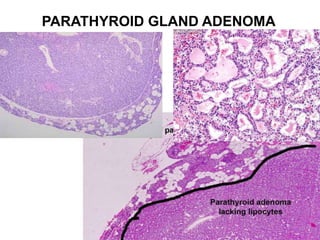 PARATHYROID GLAND ADENOMA
 