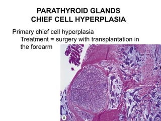PARATHYROID GLANDS
CHIEF CELL HYPERPLASIA
Primary chief cell hyperplasia
Treatment = surgery with transplantation in
the forearm
 