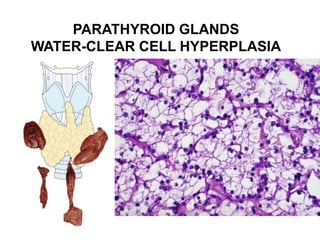 PARATHYROID GLANDS
WATER-CLEAR CELL HYPERPLASIA
 