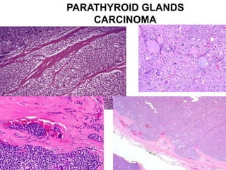 PARATHYROID GLANDS
CARCINOMA
 