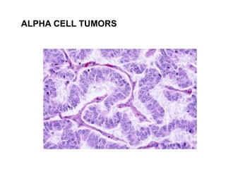 ALPHA CELL TUMORS
 