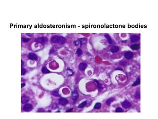 Primary aldosteronism - spironolactone bodies
 