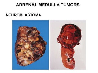 ADRENAL MEDULLA TUMORS
NEUROBLASTOMA
 