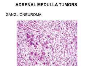 ADRENAL MEDULLA TUMORS
GANGLIONEUROMA
 