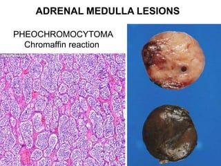 ADRENAL MEDULLA LESIONS
PHEOCHROMOCYTOMA
Chromaffin reaction
 