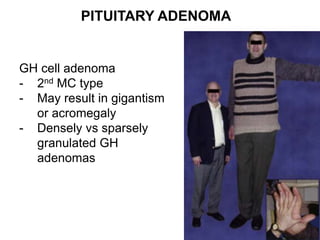 PITUITARY ADENOMA
GH cell adenoma
- 2nd MC type
- May result in gigantism
or acromegaly
- Densely vs sparsely
granulated GH
adenomas
 
