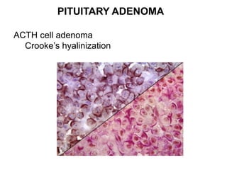 PITUITARY ADENOMA
ACTH cell adenoma
Crooke’s hyalinization
 