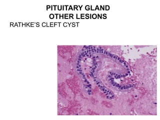 PITUITARY GLAND
OTHER LESIONS
RATHKE’S CLEFT CYST
 