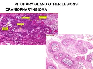 PITUITARY GLAND OTHER LESIONS
CRANIOPHARYNGIOMA
 