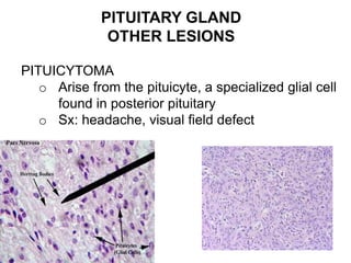 PITUITARY GLAND
OTHER LESIONS
PITUICYTOMA
o Arise from the pituicyte, a specialized glial cell
found in posterior pituitary
o Sx: headache, visual field defect
 