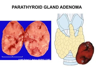 PARATHYROID GLAND ADENOMA
 