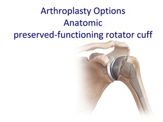Arthroplasty Options
Anatomic
preserved-functioning rotator cuff
 