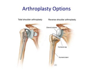 Arthroplasty Options
 