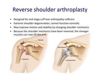 Reverse shoulder arthroplasty
• Designed for end-stage cuff tear arthropathy sufferers
• Extreme shoulder degeneration; ca...