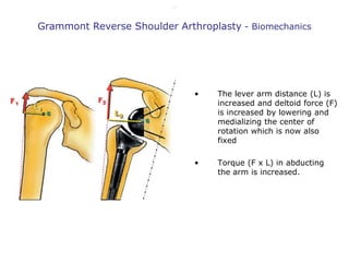 Grammont reverse TSA
• The lever arm distance (L) is
increased and deltoid force (F)
is increased by lowering and
medializ...