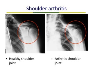 Shoulder arthritis
• Healthy shoulder
joint
• Arthritic shoulder
joint
 