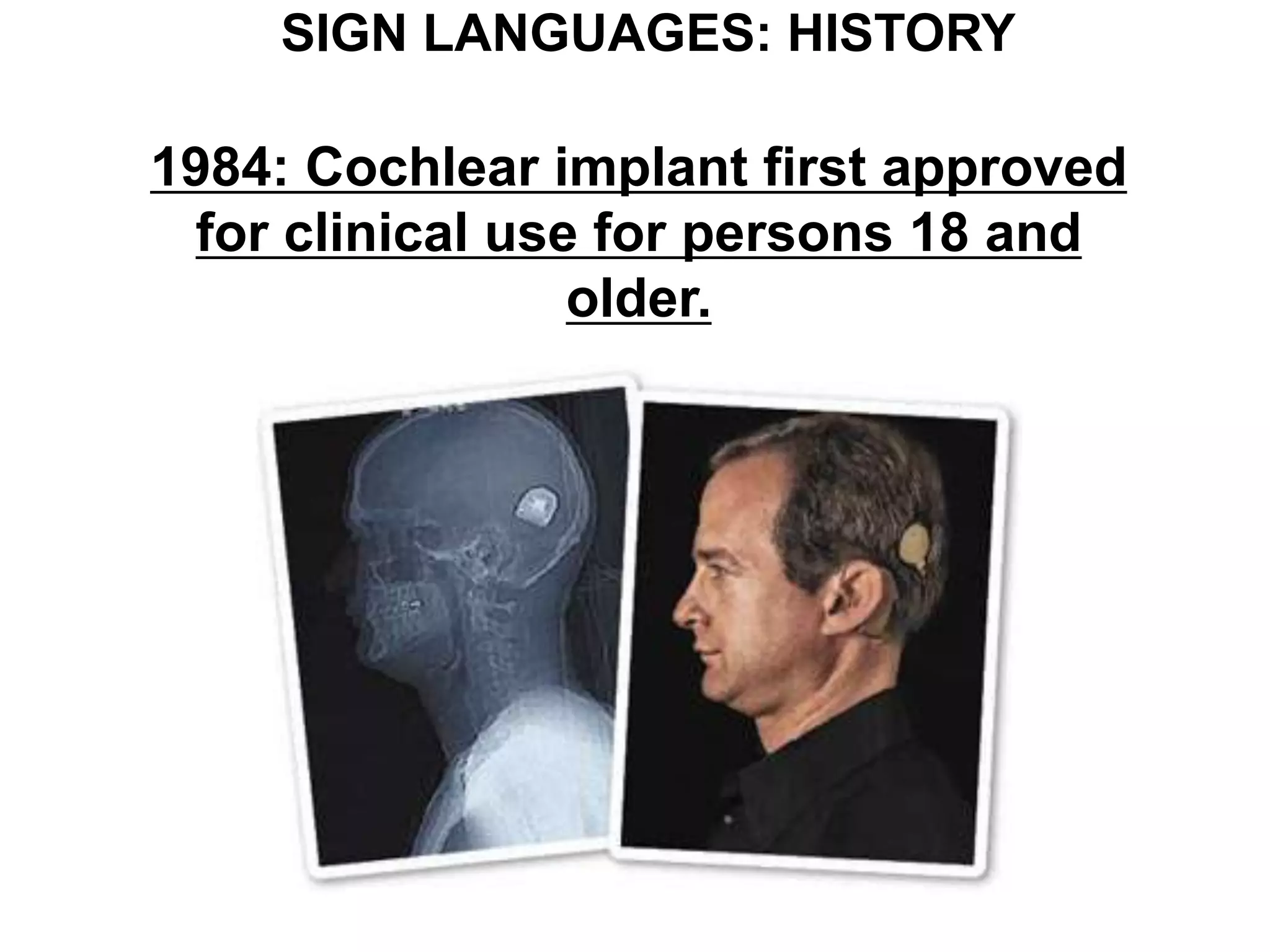 SIGN LANGUAGES: HISTORY

1984: Cochlear implant first approved
 for clinical use for persons 18 and
                 older.
 