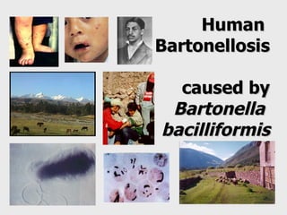 Human  Bartonellosis  caused by Bartonella  bacilliformis 