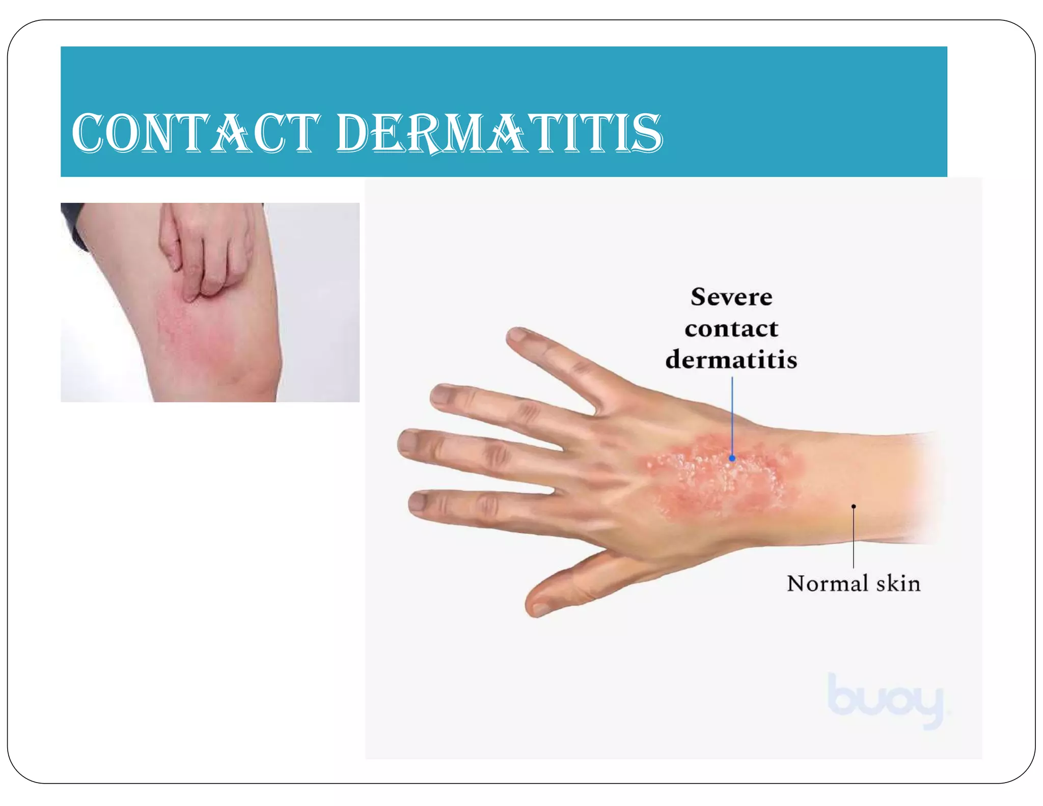 COntACt DermAtitis
 