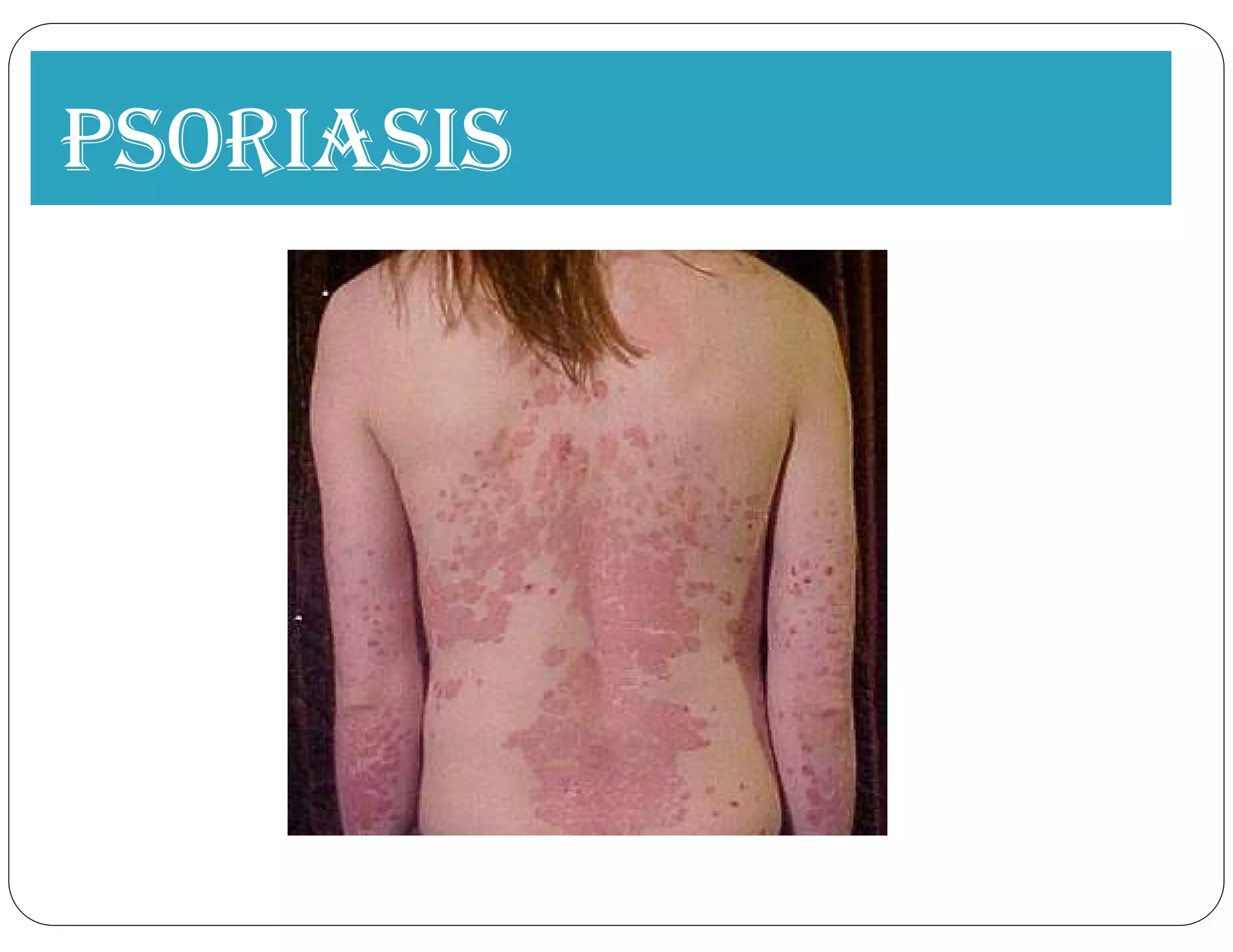 PsOriAsis
 