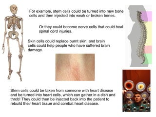 For example, stem cells could be turned into new bone
cells and then injected into weak or broken bones.
Skin cells could replace burnt skin, and brain
cells could help people who have suffered brain
damage.
Or they could become nerve cells that could heal
spinal cord injuries.
Stem cells could be taken from someone with heart disease
and be turned into heart cells, which can gather in a dish and
throb! They could then be injected back into the patient to
rebuild their heart tissue and combat heart disease.
 