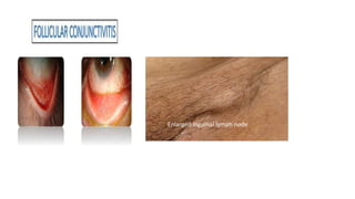 Enlarged inguinal lymph node
 