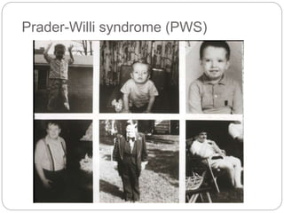 Prader-Willi syndrome (PWS)
 
