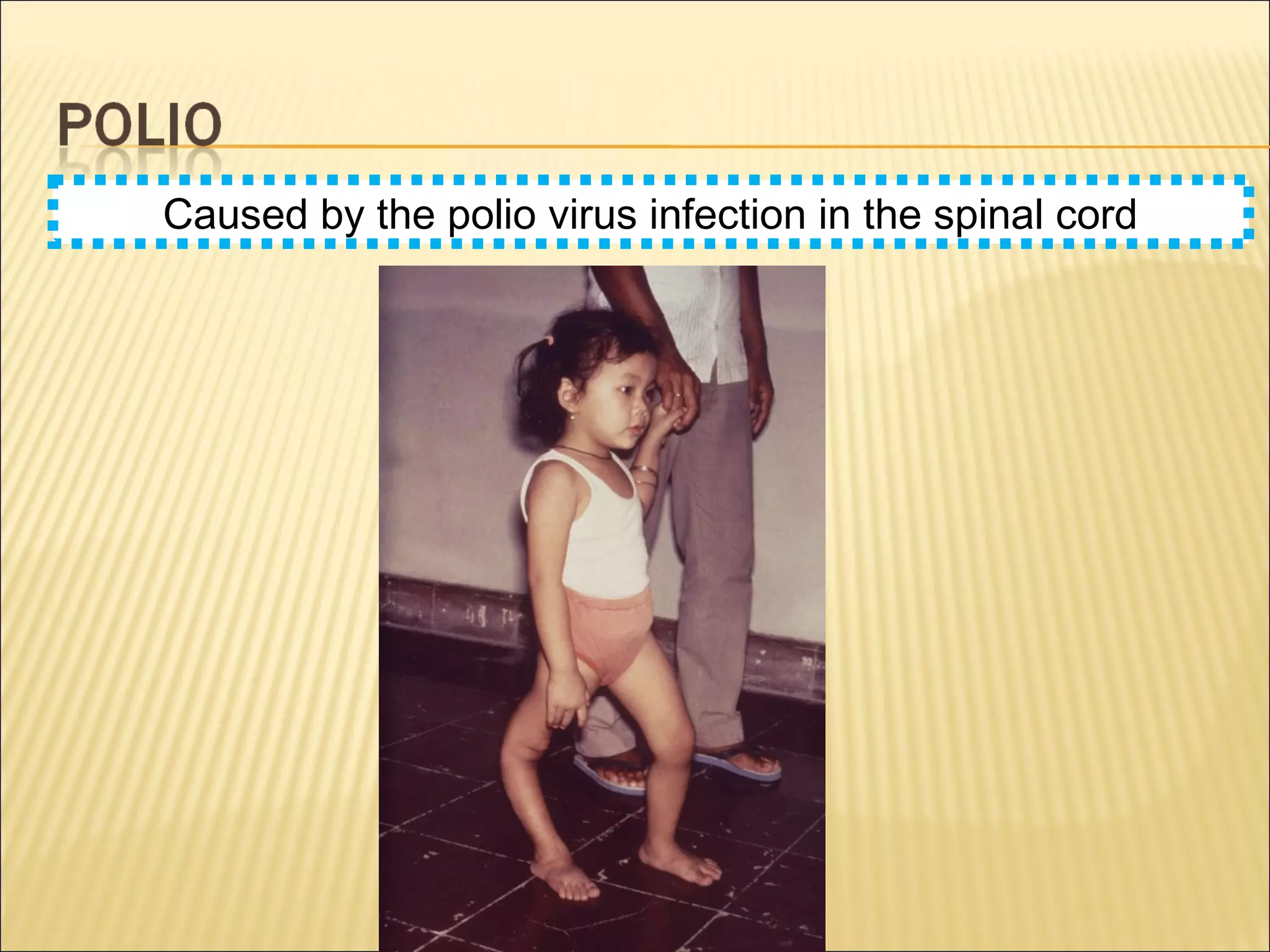 Caused by the polio virus infection in the spinal cord