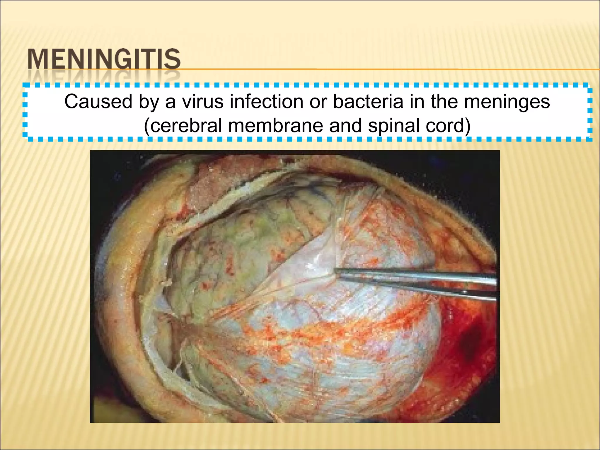 Caused by a virus infection or bacteria in the meninges
(cerebral membrane and spinal cord)