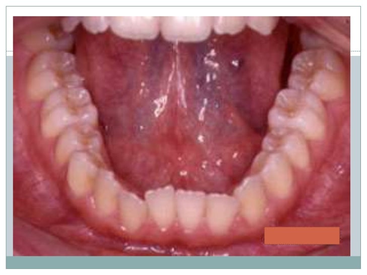 dentition