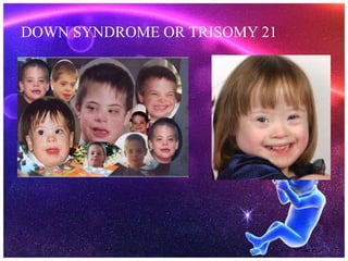 DOWN SYNDROME OR TRISOMY 21
 