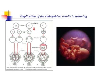 Duplication of the embryoblast results in twinning 
~70% 
 
 