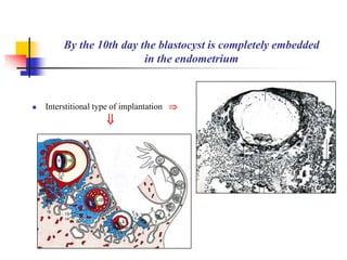 By the 10th day the blastocyst is completely embedded 
in the endometrium 
 Interstitional type of implantation  
 
 
