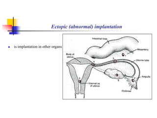 Ectopic (abnormal) implantation 
 is implantation in other organs 
 